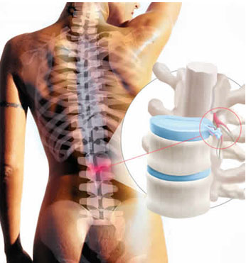 Tratamiento de la Hernias Discales con Ozono