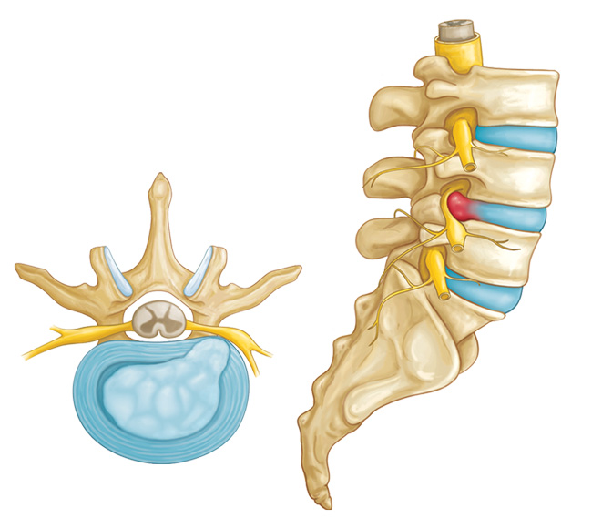 Causas de la Hernia Discal